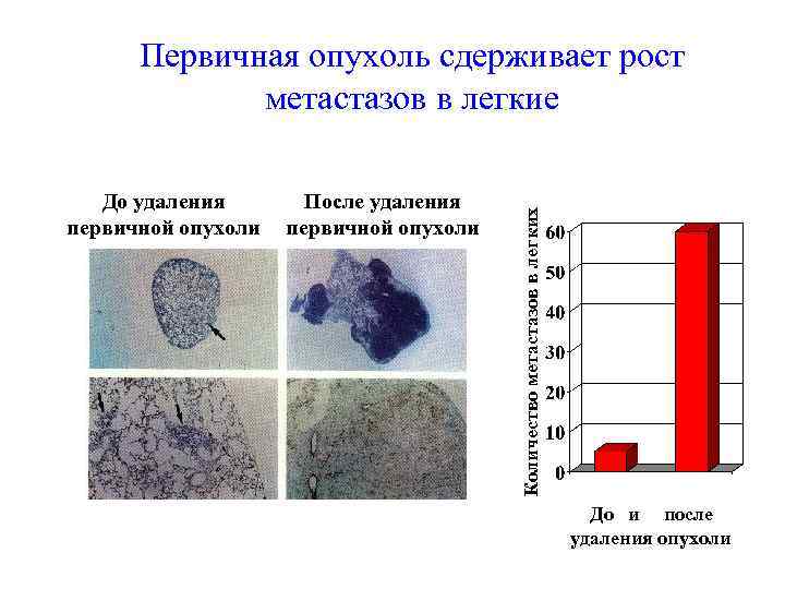 До удаления первичной опухоли После удаления первичной опухоли Количество метастазов в легких Первичная опухоль