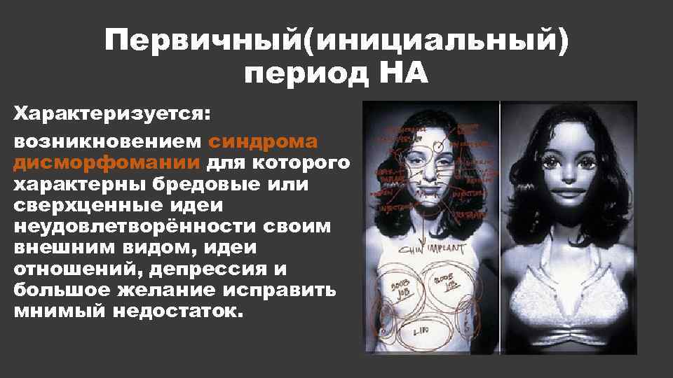Первичный(инициальный) период НА Характеризуется: возникновением синдрома дисморфомании для которого характерны бредовые или сверхценные идеи