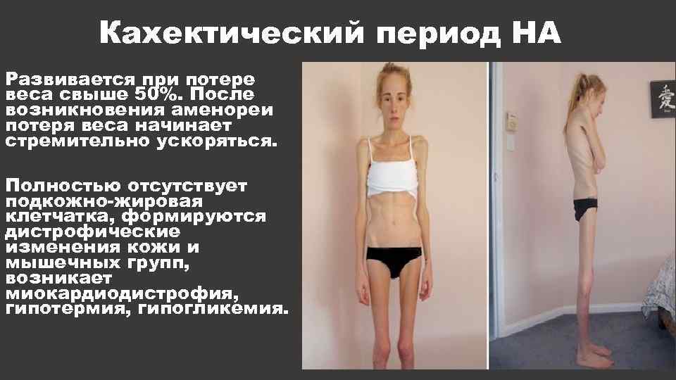 Кахектический период НА Развивается при потере веса свыше 50%. После возникновения аменореи потеря веса