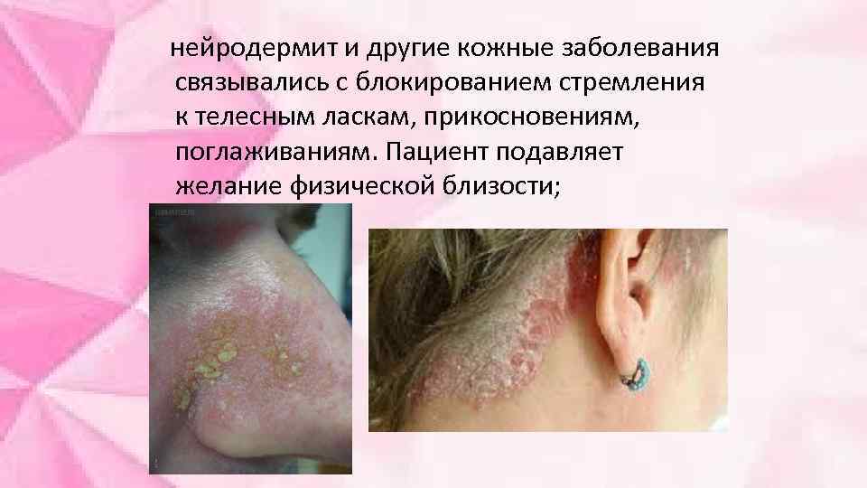  нейродермит и другие кожные заболевания связывались с блокированием стремления к телесным ласкам, прикосновениям,