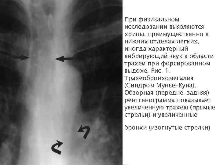При физикальном исследовании выявляются хрипы, преимущественно в нижних отделах легких, иногда характерный вибрирующий звук