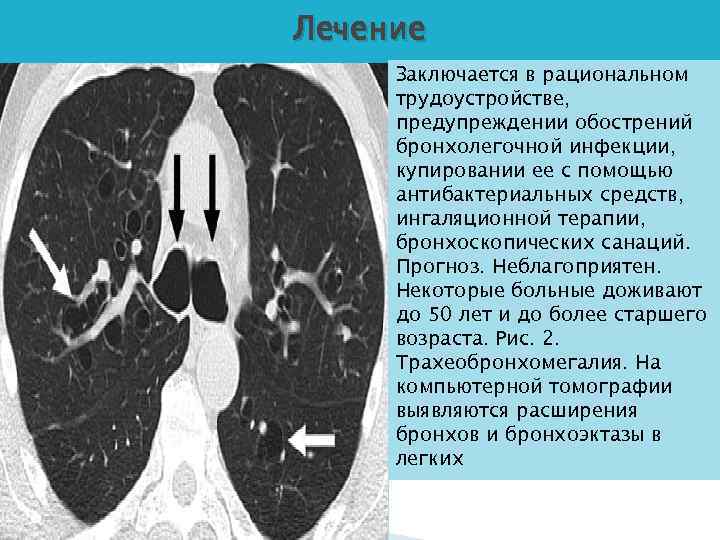 Лечение Заключается в рациональном трудоустройстве, предупреждении обострений бронхолегочной инфекции, купировании ее с помощью антибактериальных