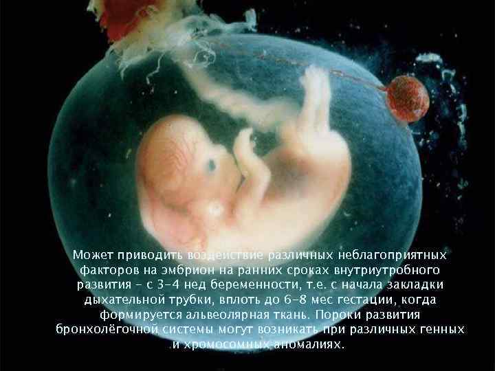 Может приводить воздействие различных неблагоприятных факторов на эмбрион на ранних сроках внутриутробного развития -