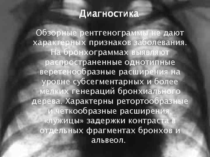 Диагностика Обзорные рентгенограммы не дают характерных признаков заболевания. На бронхограммах выявляют распространенные однотипные веретенообразные