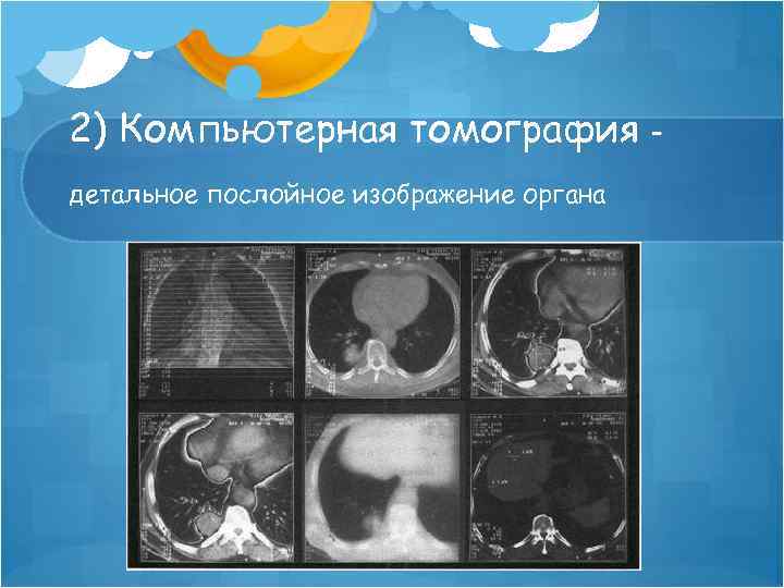 2) Компьютерная томография детальное послойное изображение органа – 