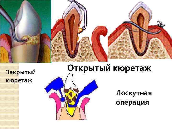 Закрытый кюретаж Открытый кюретаж Лоскутная операция 