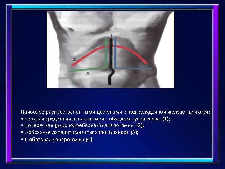 Наиболее распространенными доступами к поджелудочнои железе являются: • верхняя срединная лапаротомия с обходом пупка