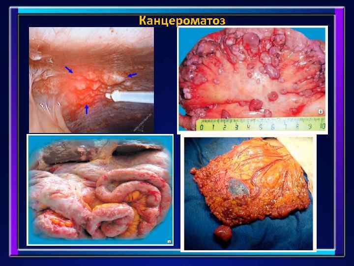 Канцероматоз 