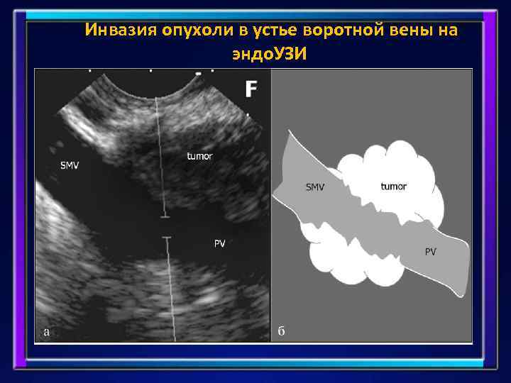 Инвазия опухоли в устье воротной вены на эндо. УЗИ 
