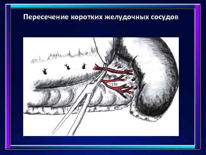 Пересечение коротких желудочных сосудов 