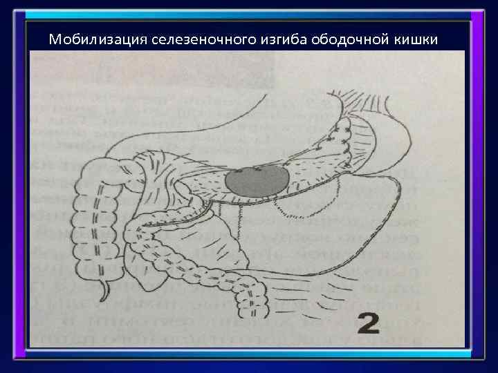 Мобилизация селезеночного изгиба ободочной кишки 