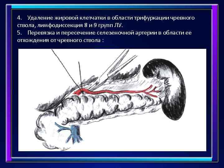 4. Удаление жировой клетчатки в области трифуркации чревного ствола, лимфодиссекция 8 и 9 групп