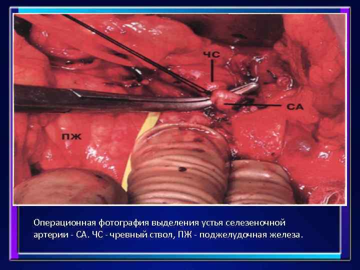 Операционная фотография выделения устья селезеночной артерии - СА. ЧС - чревный ствол, ПЖ -