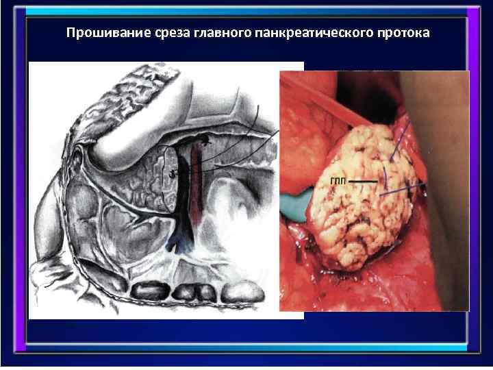 Прошивание среза главного панкреатического протока 