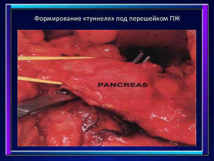 Формирование «туннеля» под перешейком ПЖ 