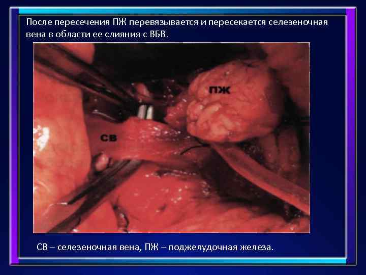 После пересечения ПЖ перевязывается и пересекается селезеночная вена в области ее слияния с ВБВ.