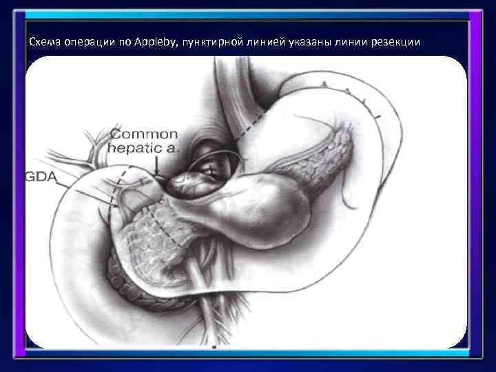  Схема операции по Appleby, пунктирной линией указаны линии резекции 