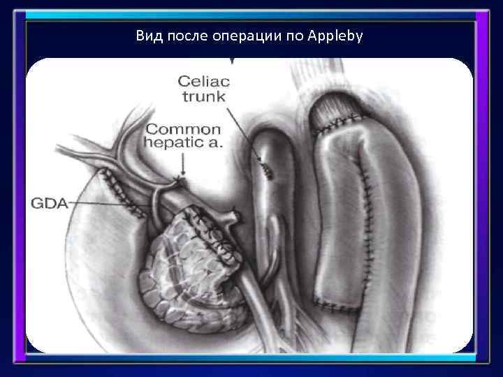 Вид после операции по Appleby 