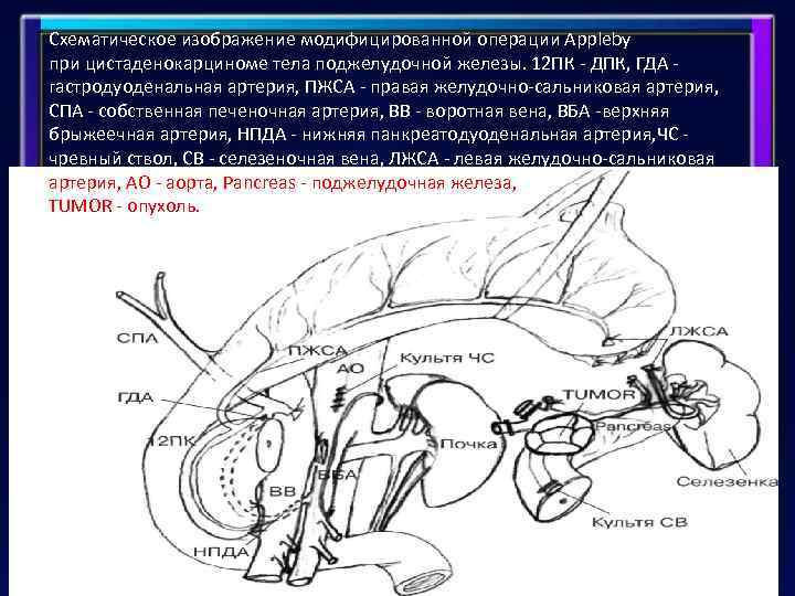 Схематическое изображение модифицированной операции Appleby при цистаденокарциноме тела поджелудочной железы. 12 ПК - ДПК,