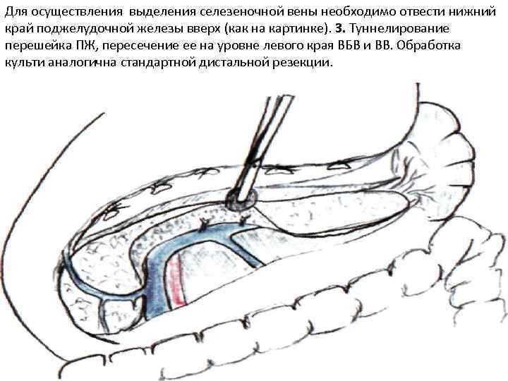 Для осуществления выделения селезеночной вены необходимо отвести нижний край поджелудочной железы вверх (как на