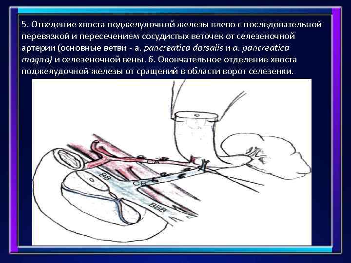 5. Отведение хвоста поджелудочной железы влево с последовательной перевязкой и пересечением сосудистых веточек от