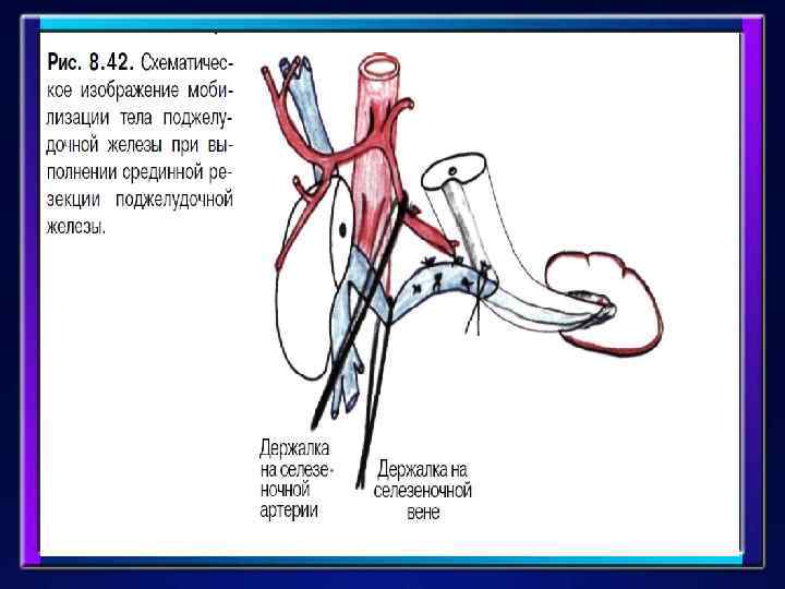 Этапы операции : 