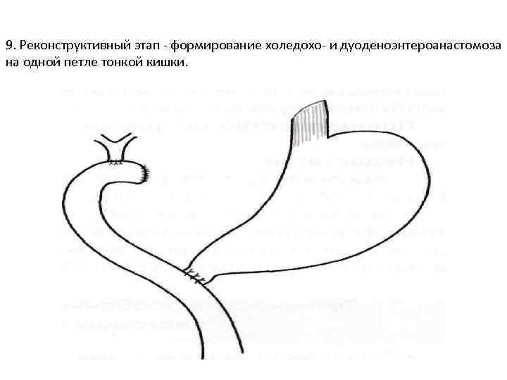 9. Реконструктивный этап - формирование холедохо- и дуоденоэнтероанастомоза на одной петле тонкой кишки. 