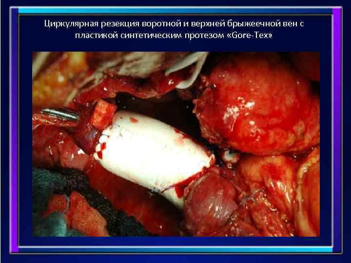 Циркулярная резекция воротной и верхней брыжеечной вен с пластикой синтетическим протезом «Gore-Tex» 