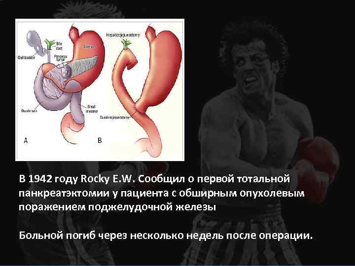 В 1942 году Rocky E. W. Сообщил о первой тотальной панкреатэктомии у пациента с