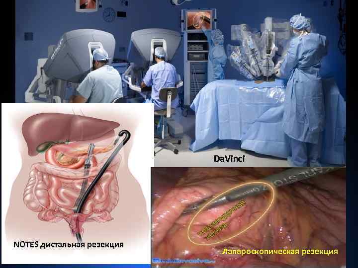 Da. Vinci NOTES дистальная резекция Лапароскопическая резекция 