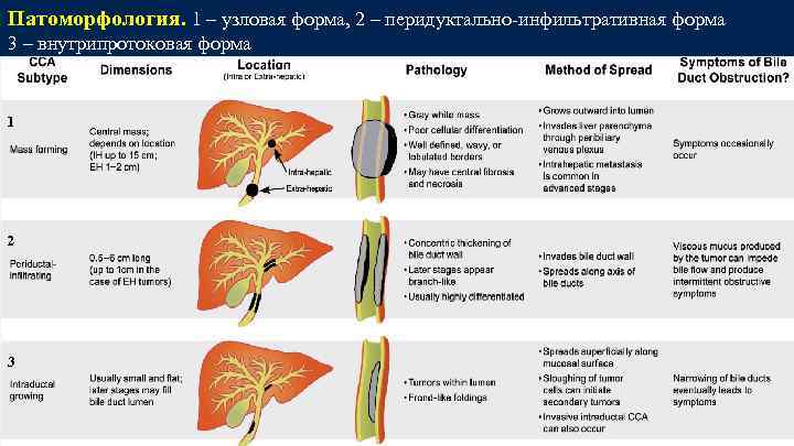 Патоморфология. 1 – узловая форма, 2 – перидуктально-инфильтративная форма Патоморфология 3 – внутрипротоковая форма