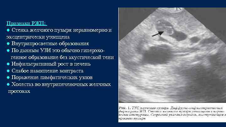 Признаки РЖП: ● Стенка желчного пузыря неравномерно и эксцентрически утолщена ● Внутрипросветные образования ●