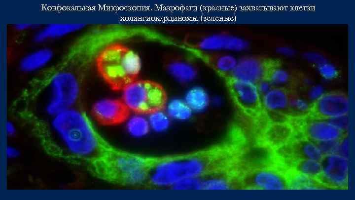 Конфокальная Микроскопия. Макрофаги (красные) захватывают клетки холангиокарциномы (зеленые) 