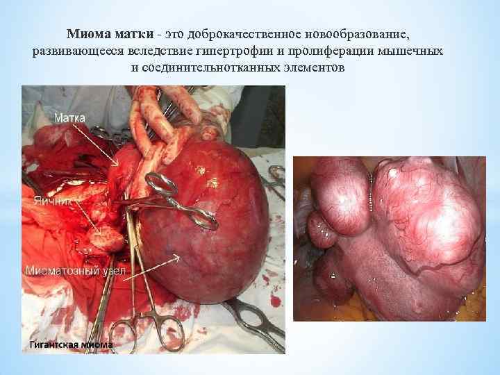 Миома матки - это доброкачественное новообразование, развивающееся вследствие гипертрофии и пролиферации мышечных и соединительнотканных