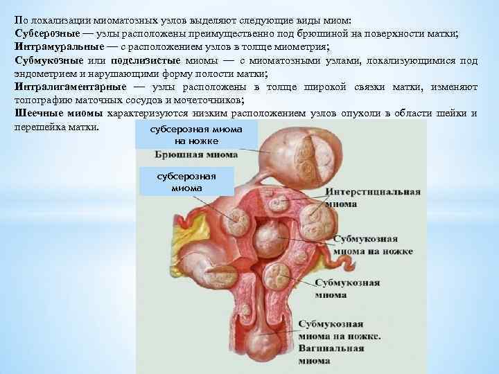 По локализации миоматозных узлов выделяют следующие виды миом: Субсерозные — узлы расположены преимущественно под