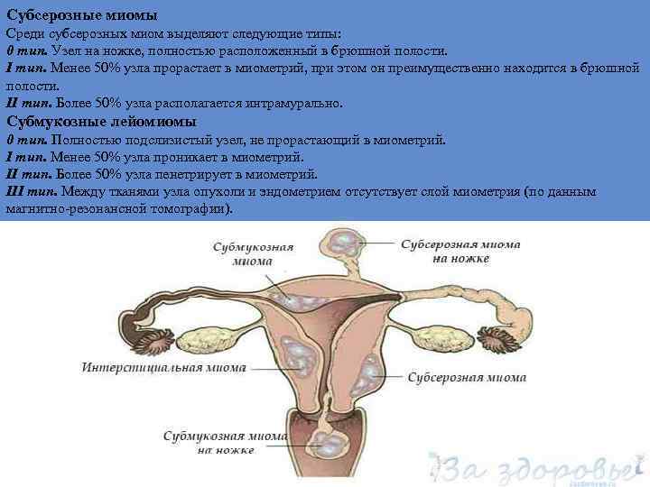 Субсерозные миомы Среди субсерозных миом выделяют следующие типы: 0 тип. Узел на ножке, полностью