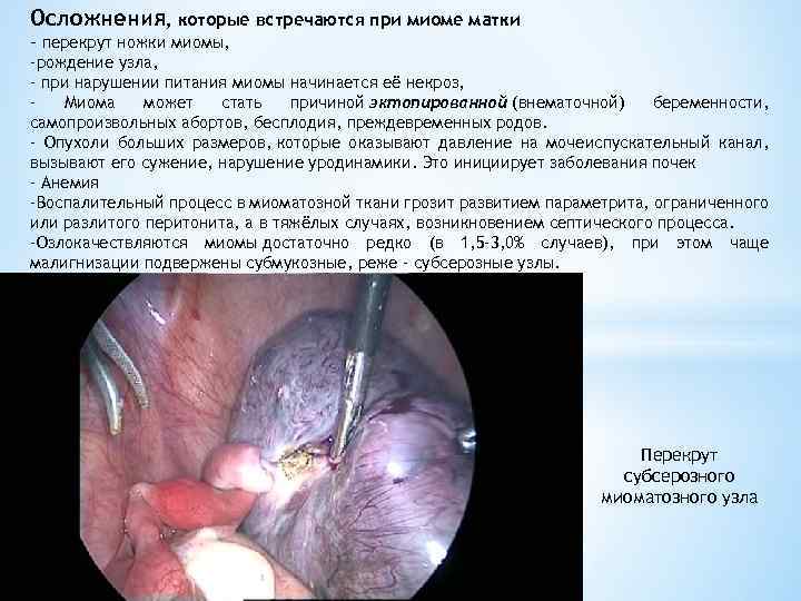 Осложнения, которые встречаются при миоме матки - перекрут ножки миомы, -рождение узла, - при