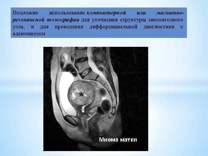 Возможно использование компьютерной или магнитнорезонансной томографии для уточнения структуры миоматозного узла, и для проведения