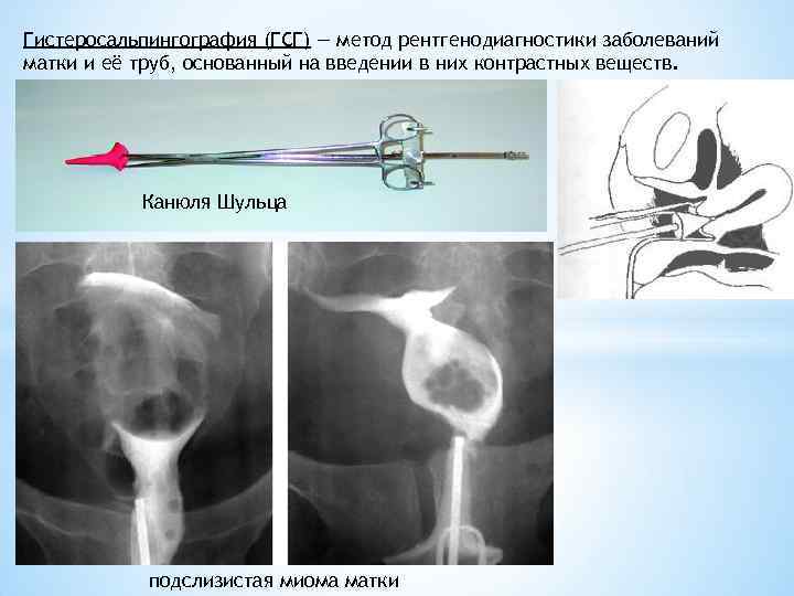 Гистеросальпингография (ГСГ) — метод рентгенодиагностики заболеваний матки и её труб, основанный на введении в