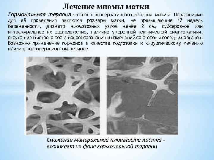 Лечение миомы матки Гормональная терапия - основа консервативного лечения миомы. Показаниями для её проведения