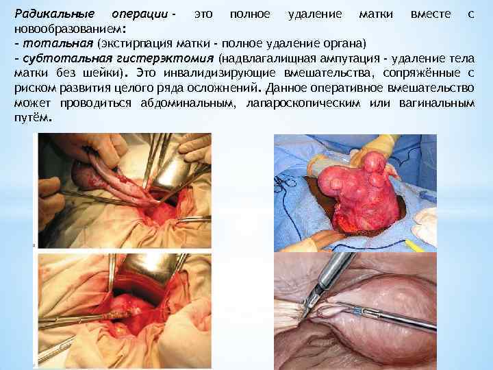 Радикальные операции - это полное удаление матки вместе с новообразованием: - тотальная (экстирпация матки