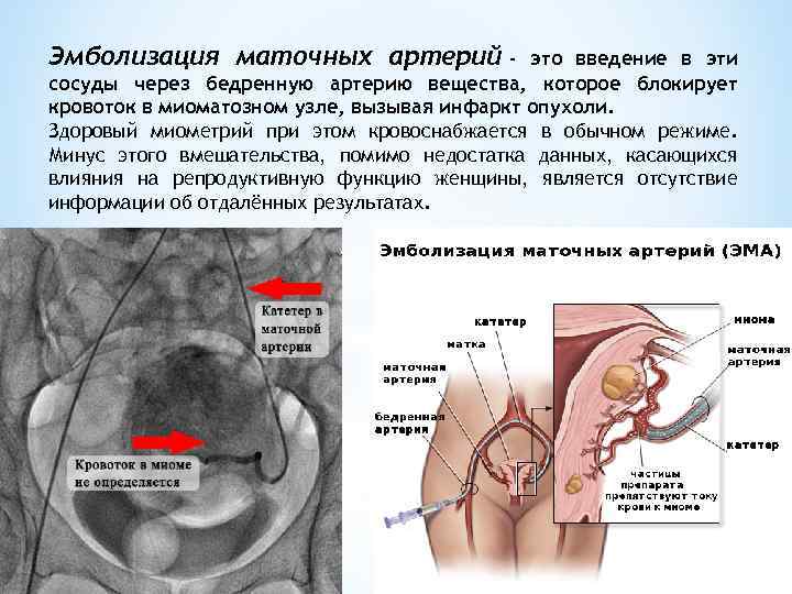 Эмболизация маточных артерий - это введение в эти сосуды через бедренную артерию вещества, которое