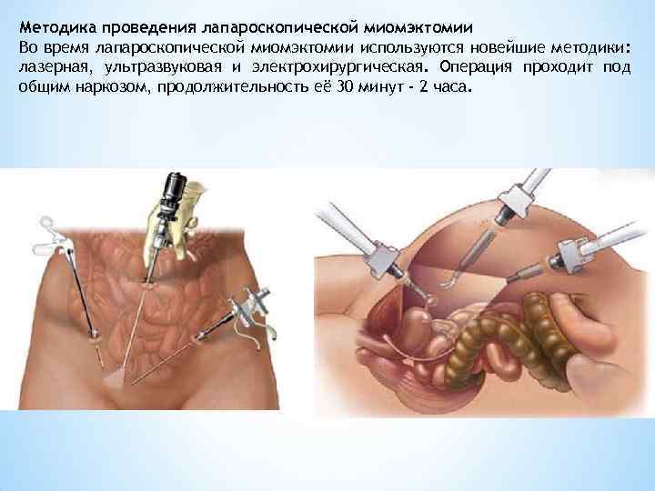 Методика проведения лапароскопической миомэктомии Во время лапароскопической миомэктомии используются новейшие методики: лазерная, ультразвуковая и