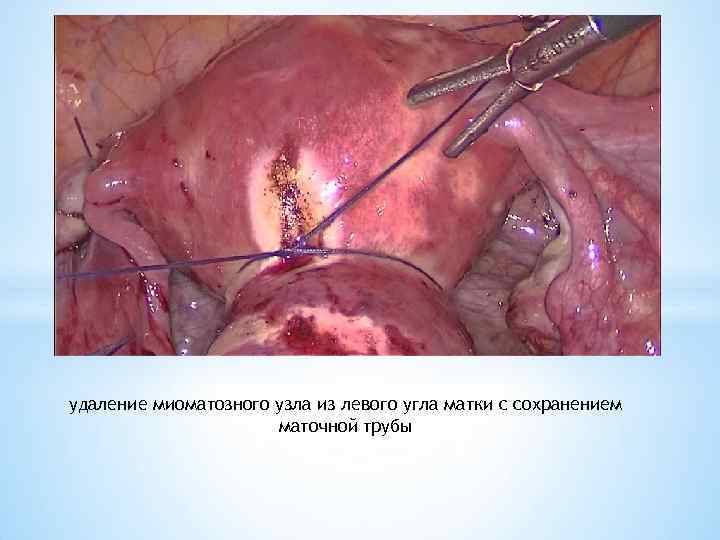 удаление миоматозного узла из левого угла матки с сохранением маточной трубы 