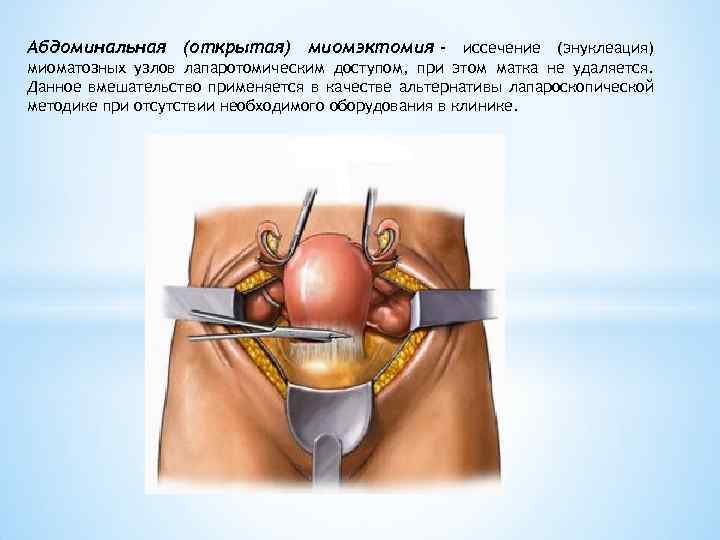 Абдоминальная (открытая) миомэктомия - иссечение (энуклеация) миоматозных узлов лапаротомическим доступом, при этом матка не