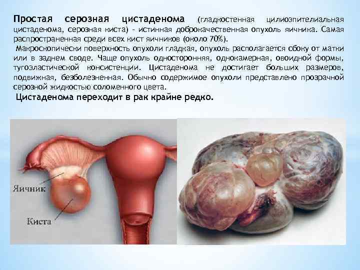 Простая серозная цистаденома (гладкостенная цилиоэпителиальная цистаденома, серозная киста) - истинная доброкачественная опухоль яичника. Самая