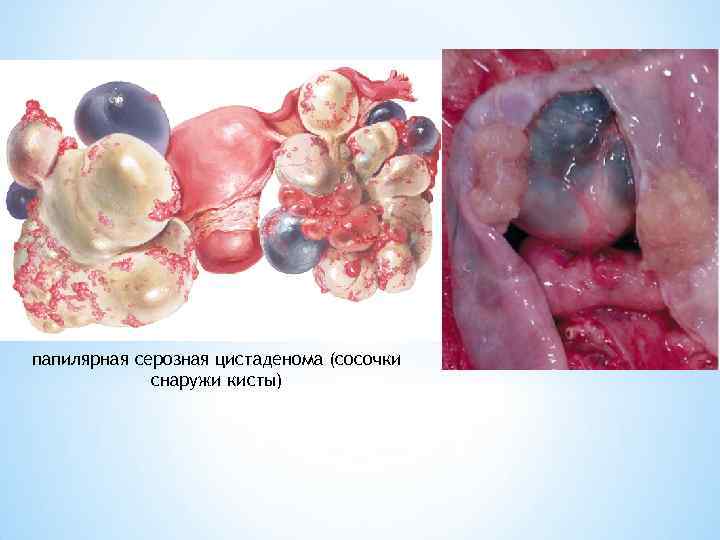 папилярная серозная цистаденома (сосочки снаружи кисты) 