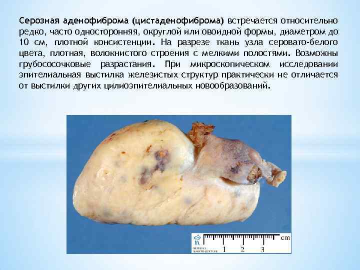 Серозная аденофиброма (цистаденофиброма) встречается относительно редко, часто односторонняя, округлой или овоидной формы, диаметром до