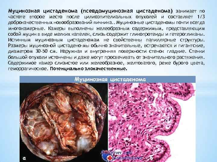 Муцинозная цистаденома (псевдомуцинозная цистаденома) занимает по частоте второе место после цилиоэпителиальных опухолей и составляет