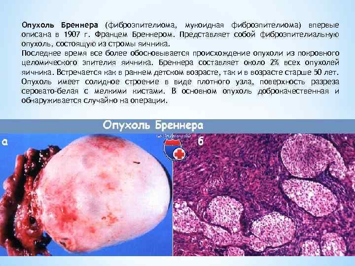 Опухоль Бреннера (фиброэпителиома, мукоидная фиброэпителиома) впервые описана в 1907 г. Францем Бреннером. Представляет собой